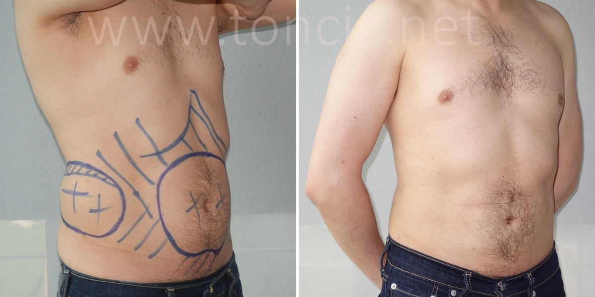 Fettabsaugung Bauch Überschüssige Haut Poliklinik dr. Tončić Fettabsaugung Bauch Überschüssige Haut Poliklinik dr. Tončić