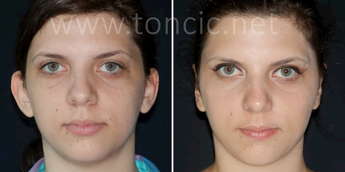 Otoplastik Ohrenkorrektur Otoplastik Zagreb Poliklinik dr.Tončić