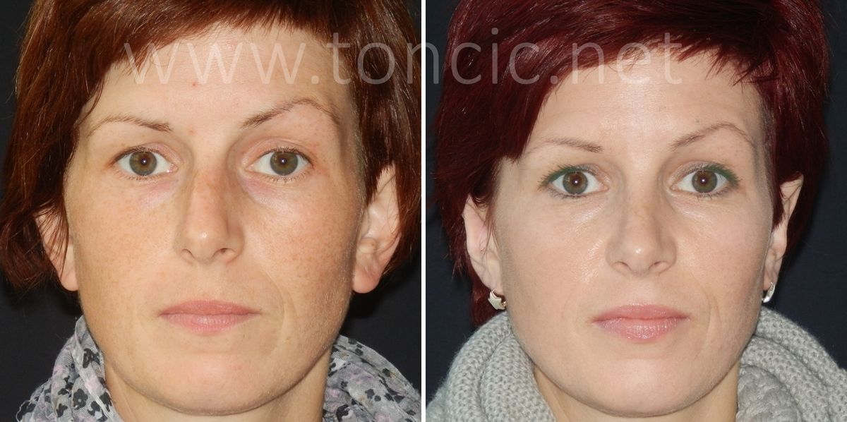 Otoplastik Schönheitschirurgie Dr. Toncic Schönheitsoperationen