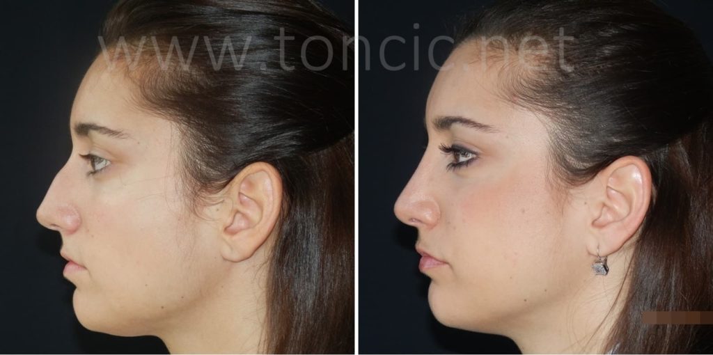 Rinoplastica - chirurgia estetica del naso | Poliklinika dr. Tončić